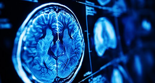 Demyelinating Disorders
